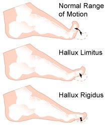 Hallux Rigidus Shoes (and Hallux Limitus)